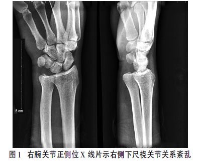 但仍无法干活,来我院行右腕关节正侧位x线片提示右侧下尺桡关节关系