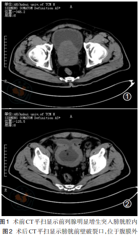 经尿道前列腺电切术中膀胱爆炸1例