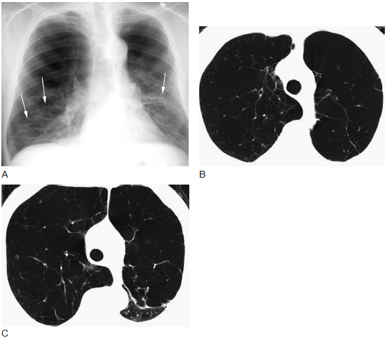 肺气肿的影像学诊断(多图)