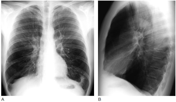 肺气肿的影像学诊断(多图)