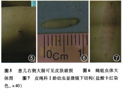 儿童蝇蛆病继发多器官损害一例