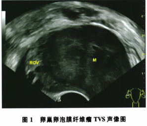 卵巢纤维瘤超声图片图片