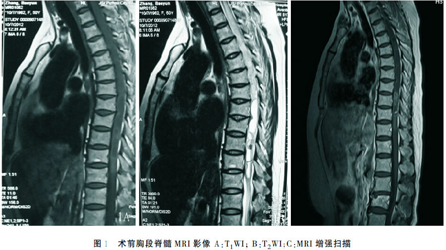 脊髓脊膜瘤图片