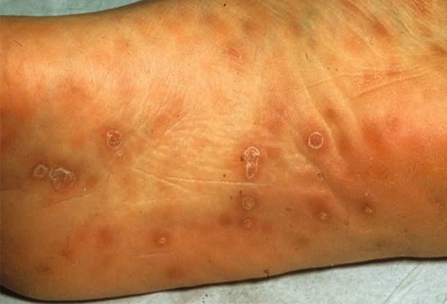 梅毒引起的皮肤损害包括躯干丘疹鳞屑性皮损,手掌和脚掌补丁样皮肤