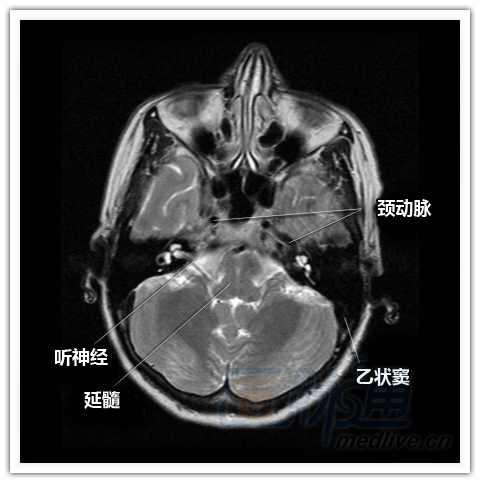 乙状窦断层解剖图片图片