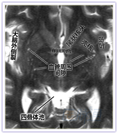 垂体解剖图冠状图片