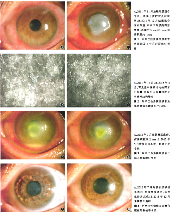 2012年5月复诊,眼科检查溃疡迁延不愈,角膜上皮出现小泡(见图3b),角膜