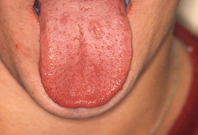 二期梅毒舌头图片图片