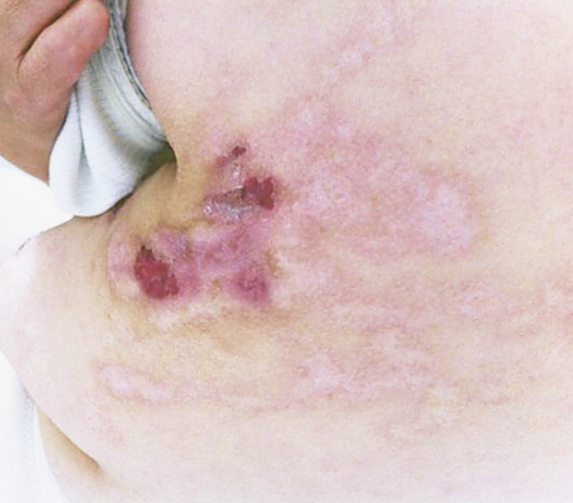 三期梅毒疹图片