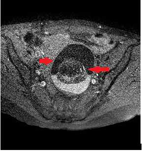 畸胎瘤脂液分层征图片