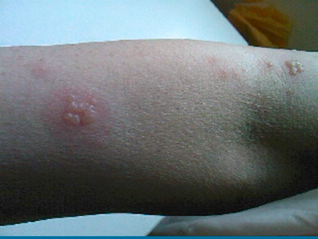 丘疹性荨麻疹水泡图片