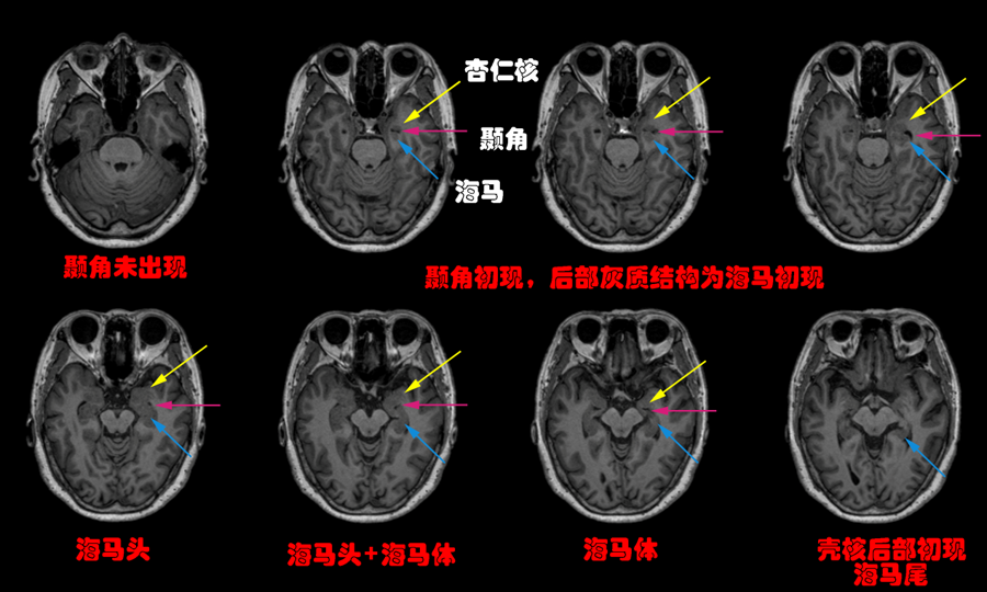 几个小技巧,教你在mri上轻松识别边缘系统