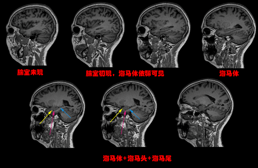 头和杏仁核,略有不同的是,矢状位上从外到内先露出的是脑室和海马体