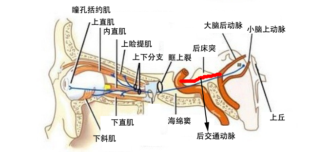 看美剧聊动眼神经麻痹与颅内动脉瘤的前世今生