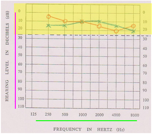 冀飞:眩晕患者的听力学检查简介