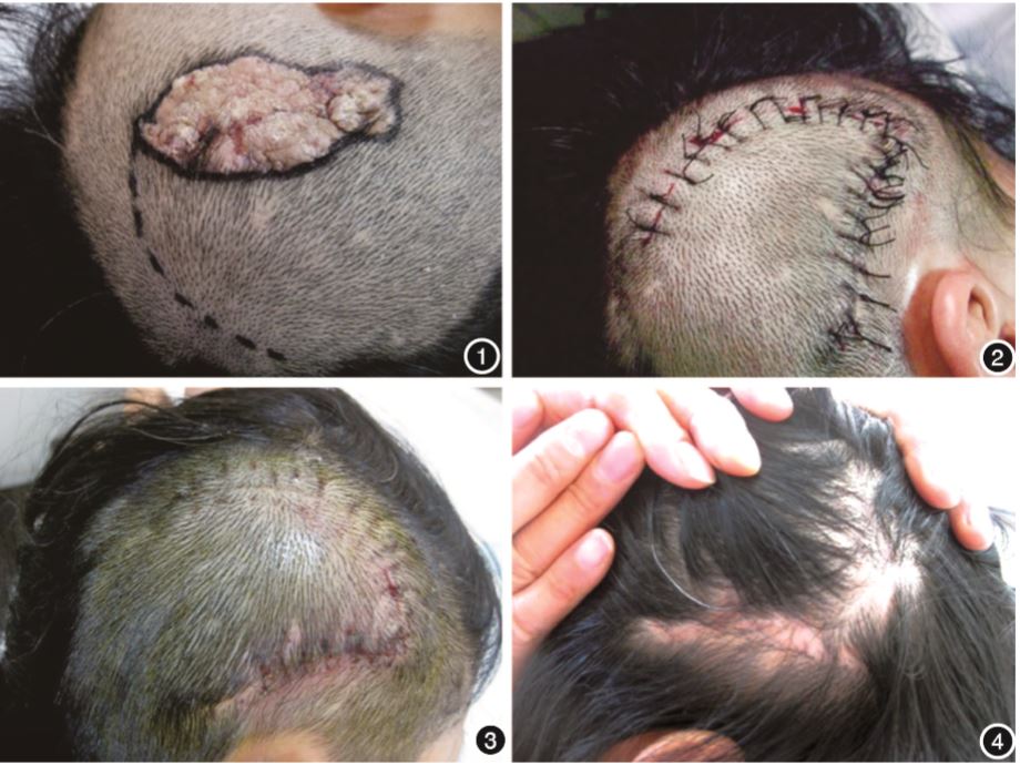 毛发本组22例患者术后皮瓣均成活,无皮瓣大面积坏死,手术切口感染等
