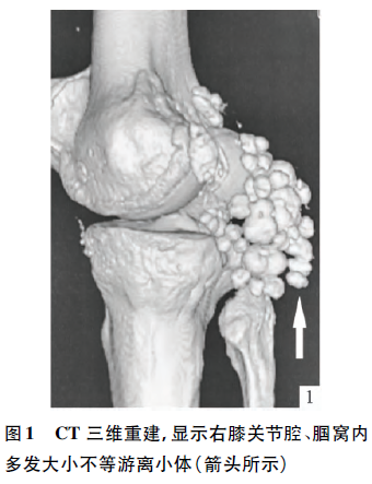 膝关节滑膜软骨瘤1例
