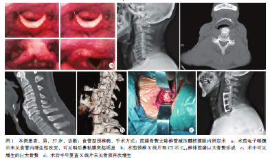 食管型颈椎病1例