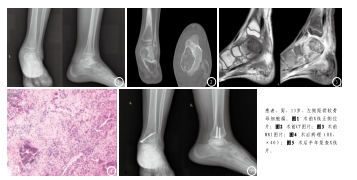 距骨软骨母细胞瘤1例