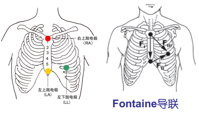 胸骨导联位置示意图图片