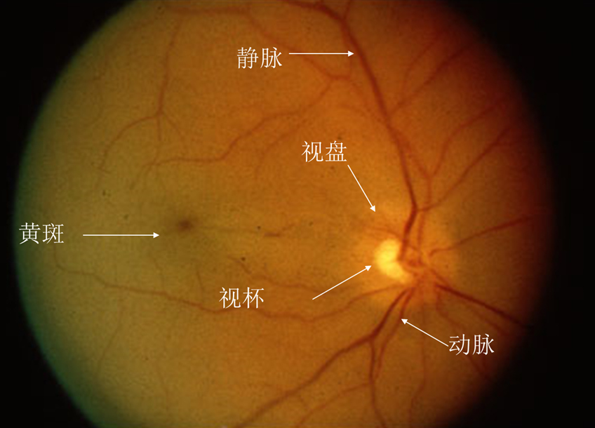 正常眼底照片高清图片图片