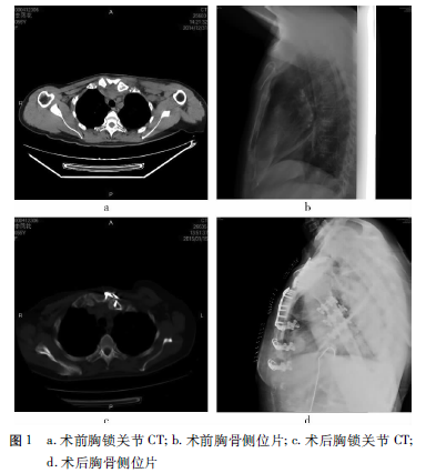 胸骨柄體脫位切開復位鎖定加壓鋼板螺釘內固定術 胸腔鏡右側胸腔探查