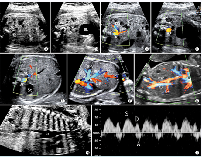 胎儿静脉导管图片图片