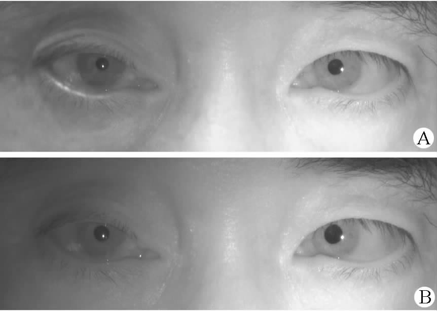 图2  室内光线下(a)与暗光下(b)双侧瞳孔大小差异对比:暗光下瞳孔不等