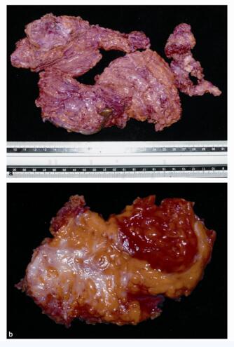 卡波西肉瘤