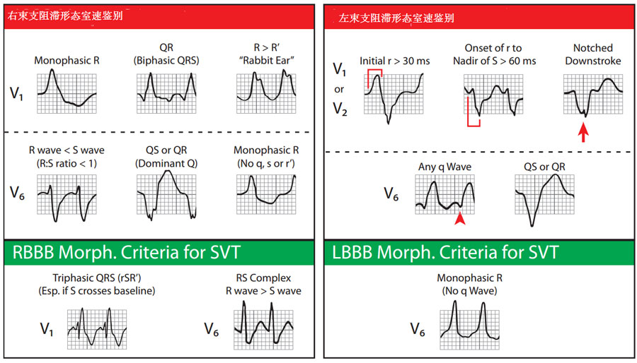 你是否见过窄qrs波的室速?(附室速的心电图鉴别方法)