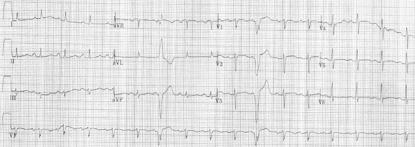 胸痛+心梗标志物升高+ST-T异常=急性心梗?