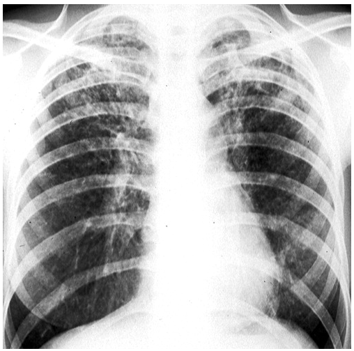 继发性肺结核的影像特征