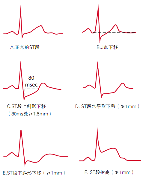 肥厚……常见心肌疾患的心电图表现