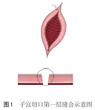 子宫背带式缝合术步骤图片