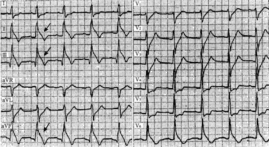 这些少见的心电图异常波,你听说过吗?