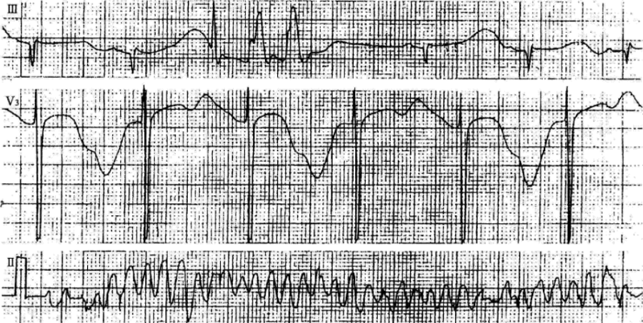这些少见的心电图异常波,你听说过吗?