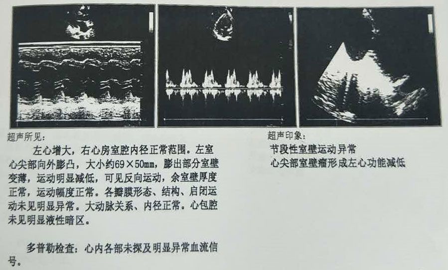 超声心动图检查结果