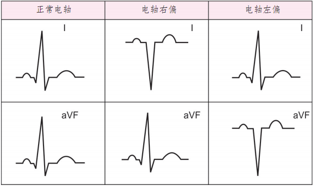 心电图无人区电轴图片