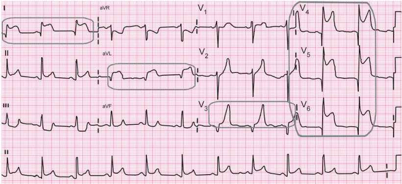 急性心梗心电图特点图片