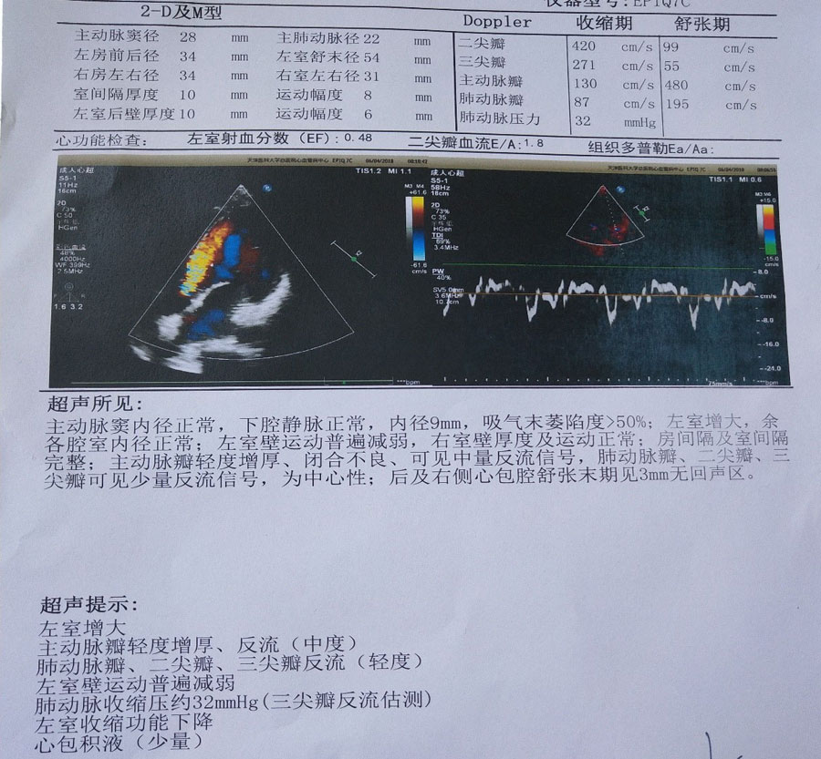 超声心动图检查结果