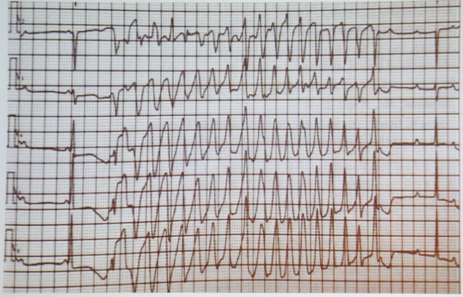 王斌教授:注意了,这些心电图指标预示着恶性心律失常!