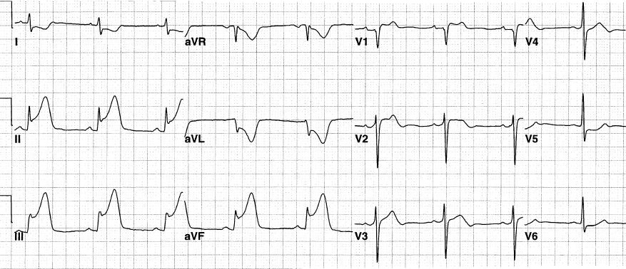下壁心梗心电图图片图片