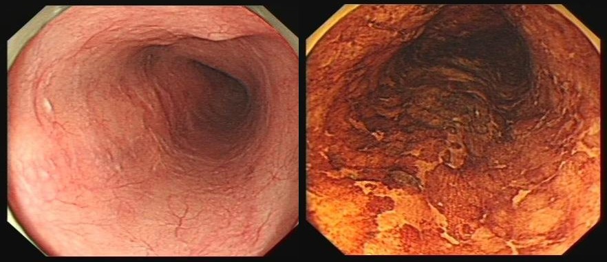 食管癌缩窄型图片图片