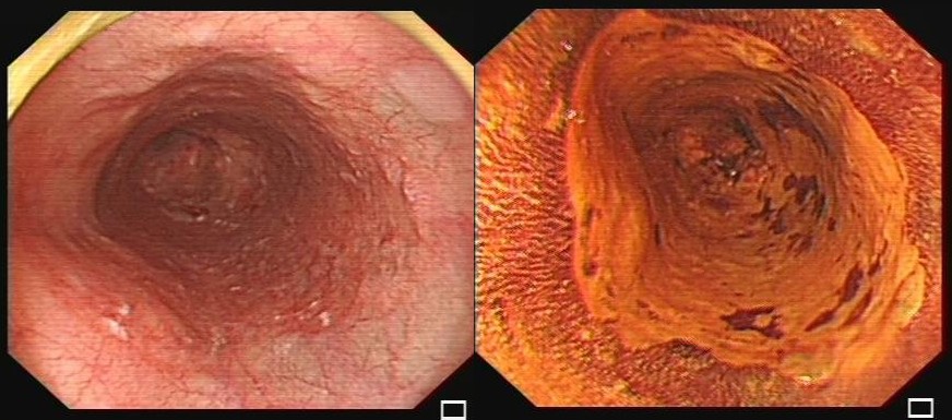 食管肿瘤早期症状图片图片