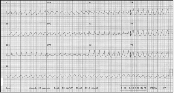室性心动过速的心电图特征包括:(1)宽qrs波群;(2)心率