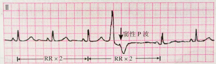 期前收缩心电图特点图片
