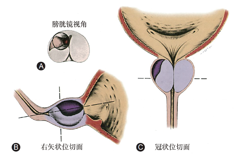 前列腺增生手术示意图图片