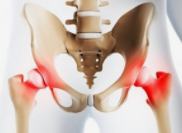 股骨髋臼撞击综合征的诊断与治疗研究进展