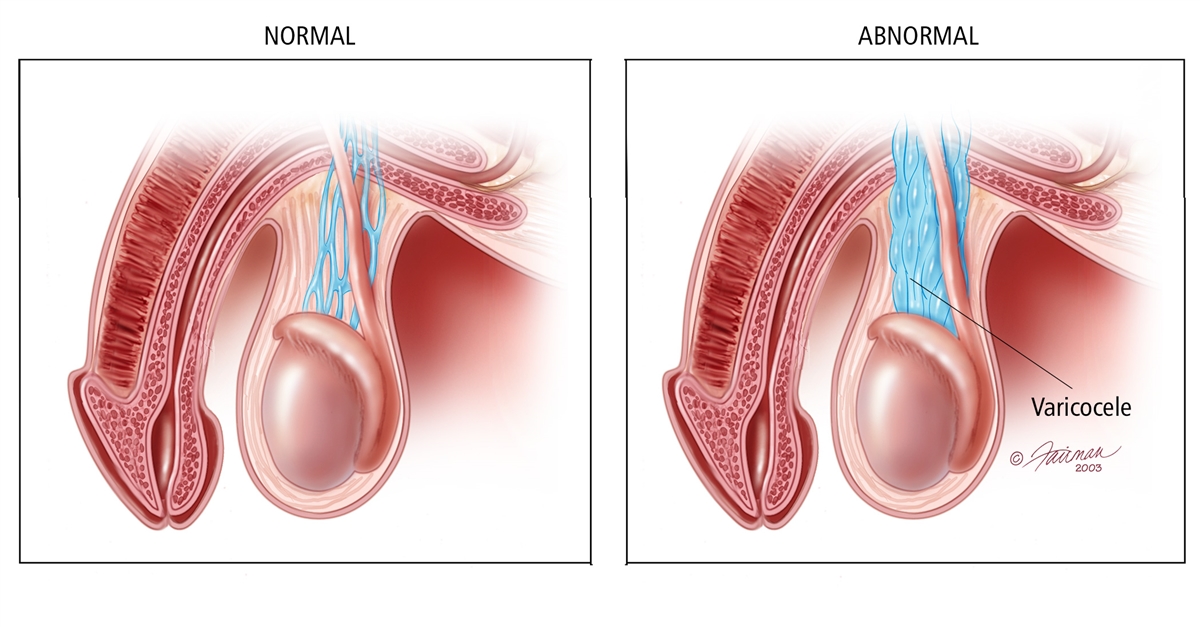 精索静脉曲张是指阴囊蔓状静脉丛血管的异常扩张
