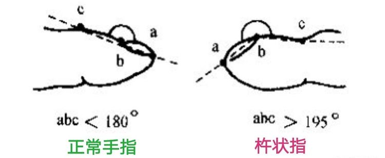 杵状指的测量方法图片图片